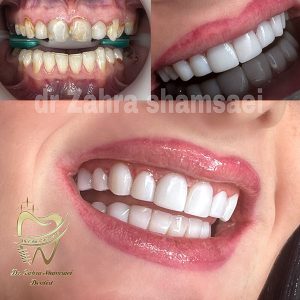 کامپوزیت ونیر سوئیسی - دکتر زهرا شمسایی دندانپزشک سعادت آباد