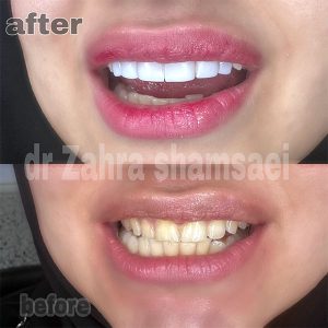 کامپوزیت ونیر سوئیسی - دکتر زهرا شمسایی دندانپزشک سعادت آباد