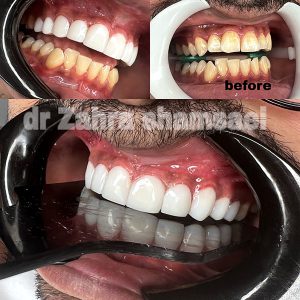 کامپوزیت ونیر سوئیسی - دکتر زهرا شمسایی دندانپزشک سعادت آباد