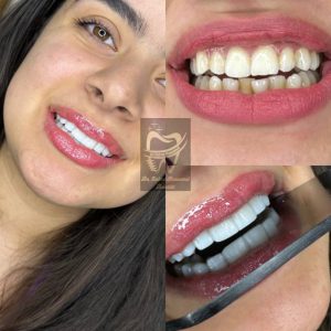 کامپوزیت - دکتر زهرا شمسایی دندانپزشک سعادت آباد