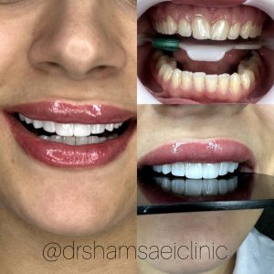 کامپوزیت - دکتر زهرا شمسایی دندانپزشک سعادت آباد