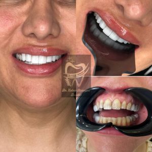 کامپوزیت - دکتر زهرا شمسایی دندانپزشک سعادت آباد