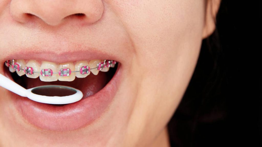 ارتودنسی دندان چیست - دندانپزشکی دکتر زهرا شمسایی