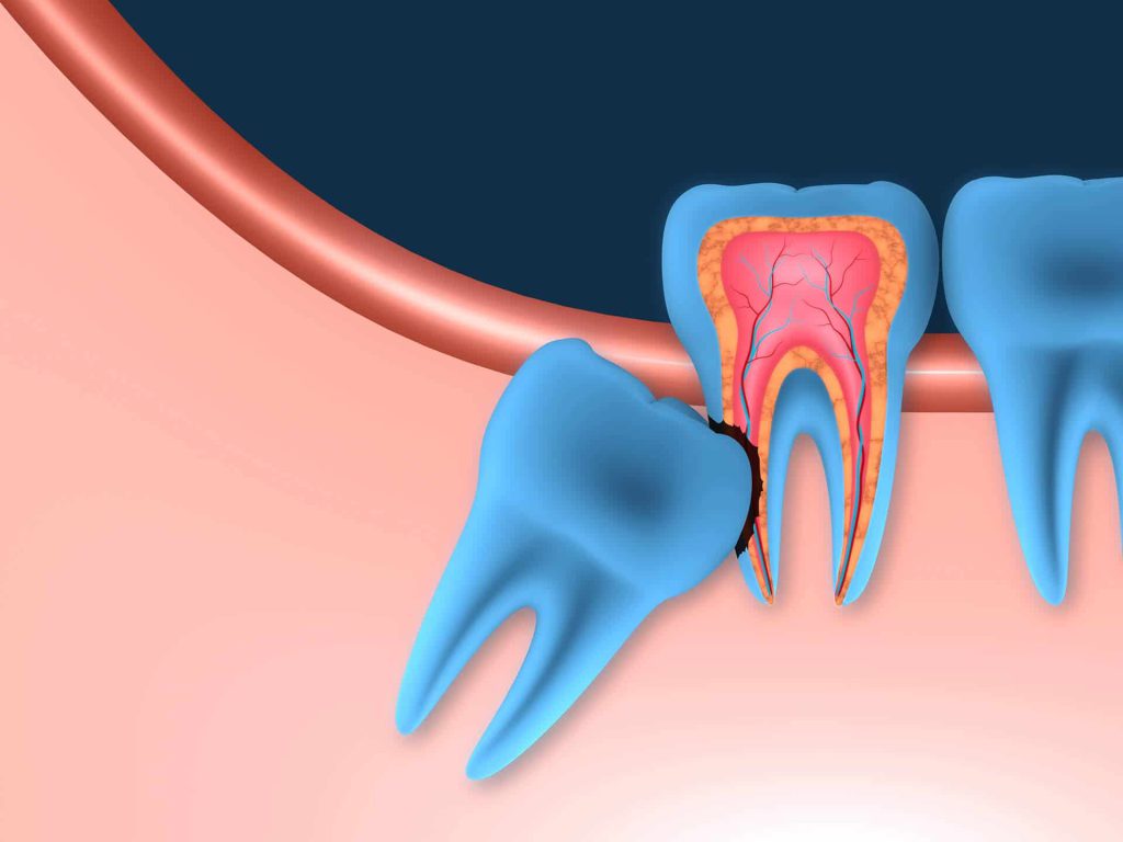 ترس از کشیدن دندان عقل - کلینیک دندانپزشکی دکتر زهرا شمسایی