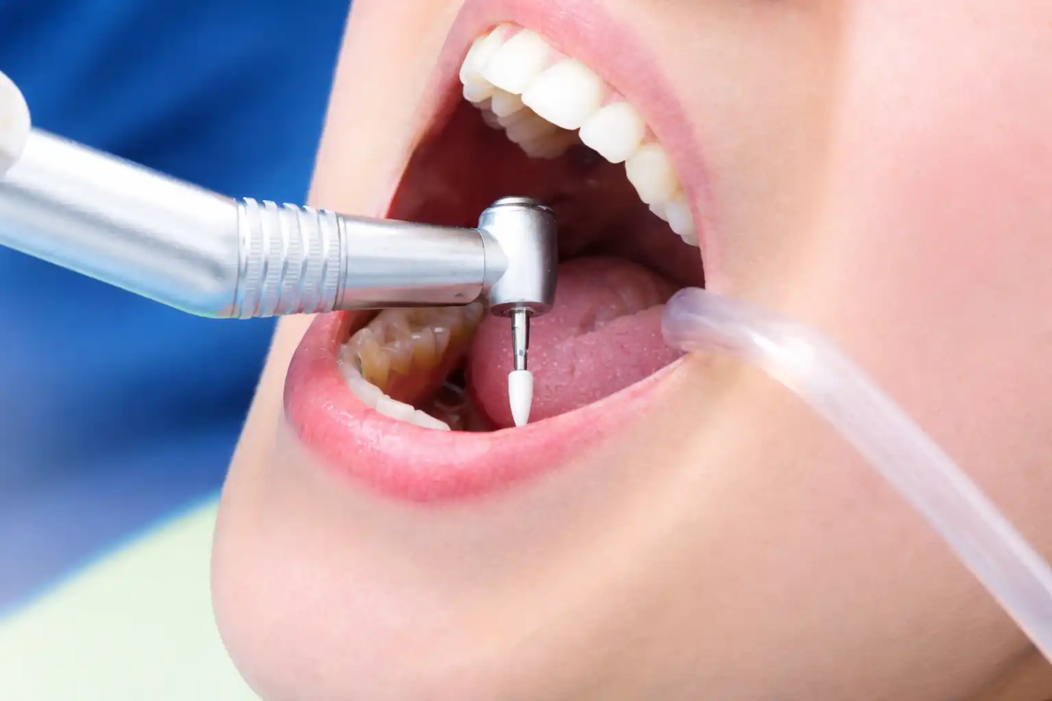 عصبکشی دندان چگونه انجام میشود