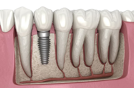 ایمپلنت دندان - دکتر زهرا شمسایی