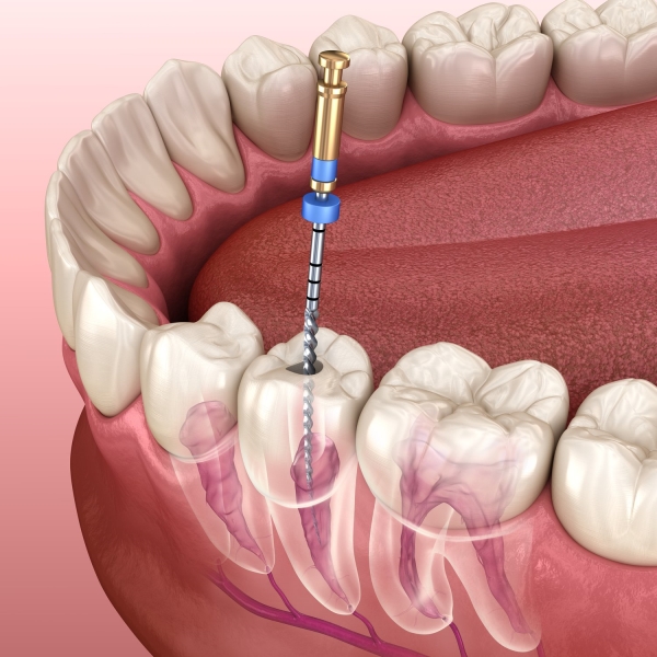 عوارض عصب کشی دندان - دکتر زهرا شمسایی