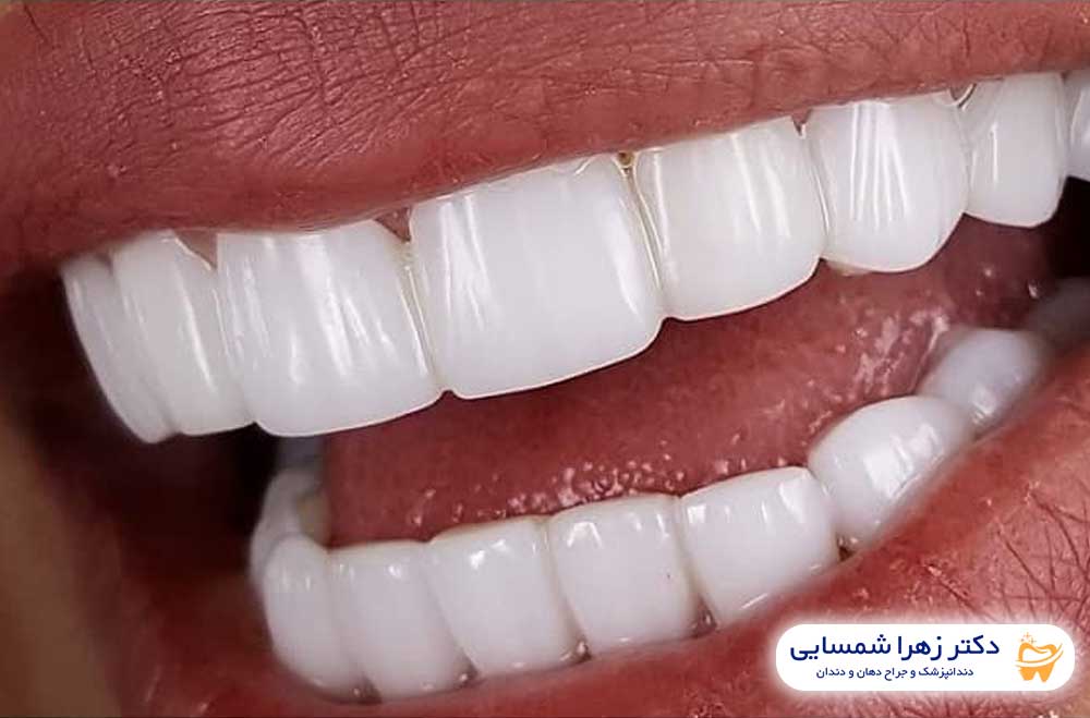 کامپوزیت دندان چیست - کلینیک دکتر زهرا شمسایی