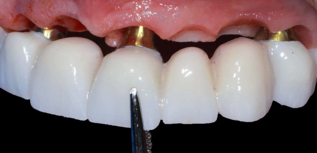 کاشت دندان - دکتر زهرا شمسایی