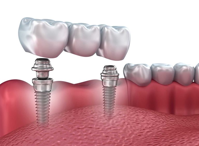 ایمپلنت دندان - کلینیک دکتر زهرا شمسایی