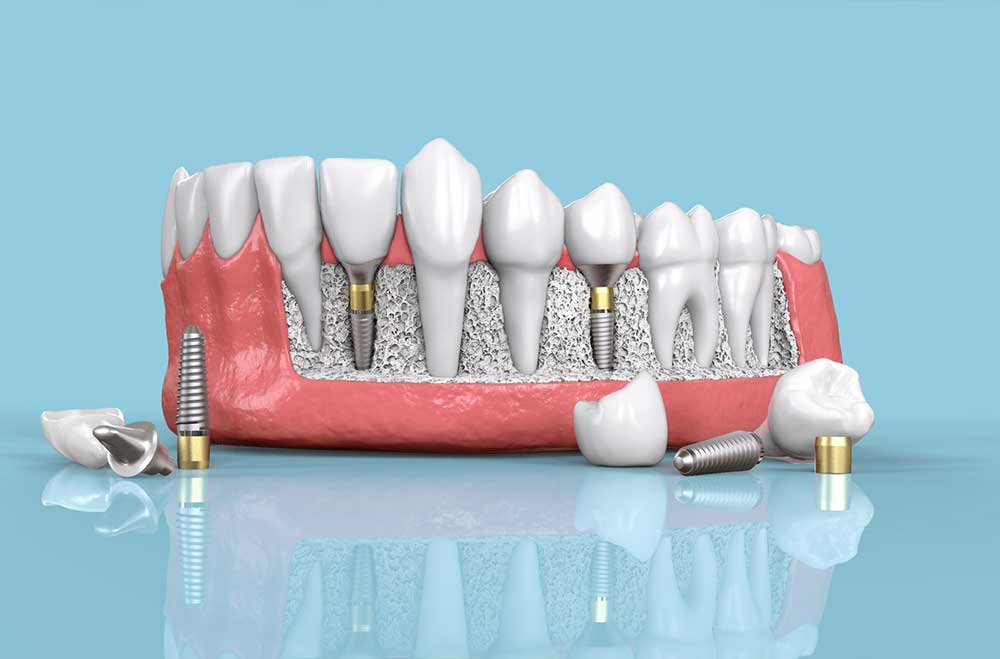 کاشت دندان - کلینیک دکتر زهرا شمسایی