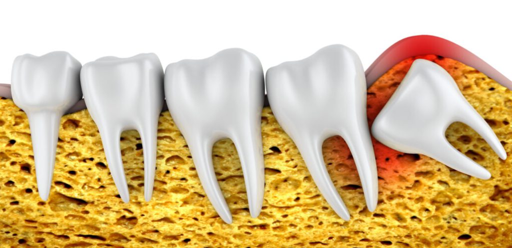 ترس از کشیدن دندان عقل - کلینیک دکتر زهرا شمسایی