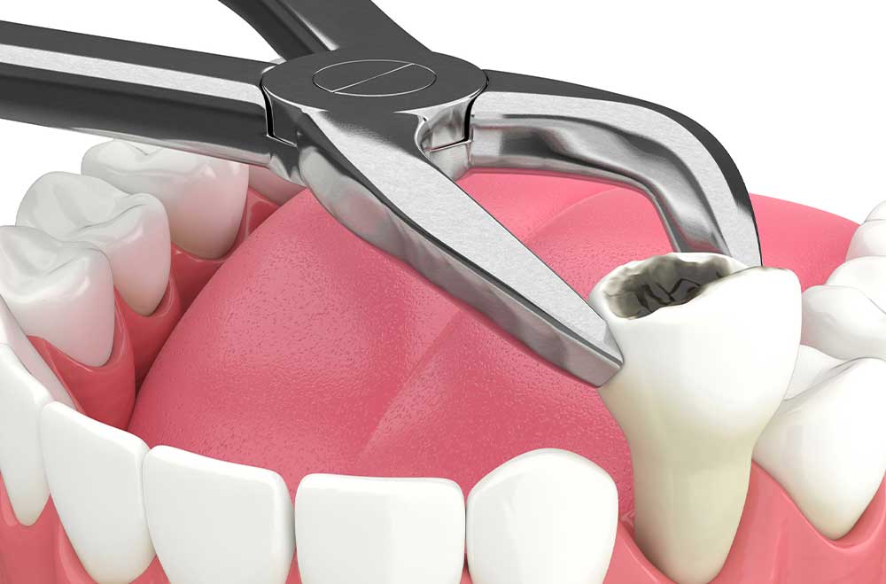 ترس از کشیدن دندان عقل - کلینیک دکتر زهرا شمسایی