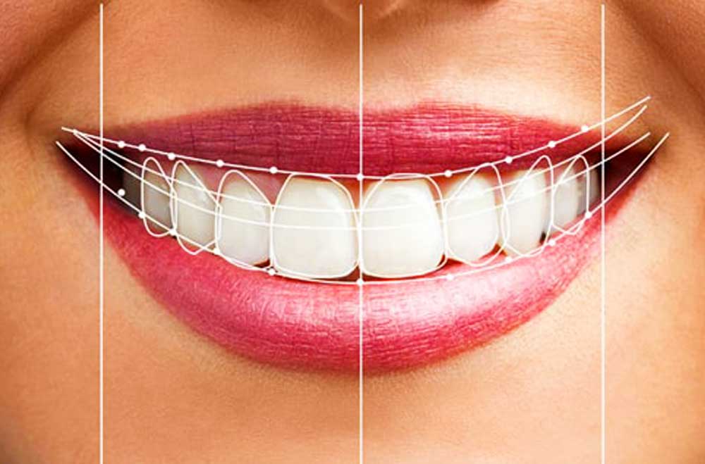 کامپوزیت دندان یا لمینت دندان - دکتر زهرا شمسایی