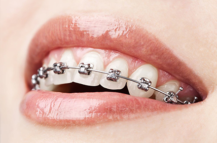 ارتودنسی دندان - کلینیک دندانپزشکی دکتر شمسایی