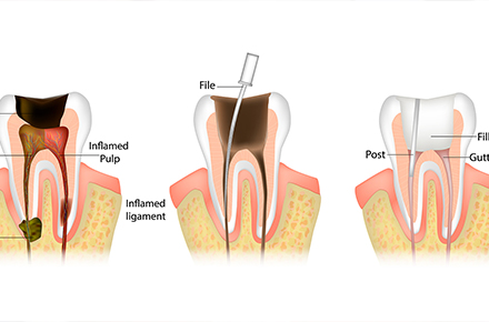 عصب‌ کشی دندان - کلینیک دکتر زهرا شمسایی
