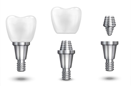 ایمپلنت دندان