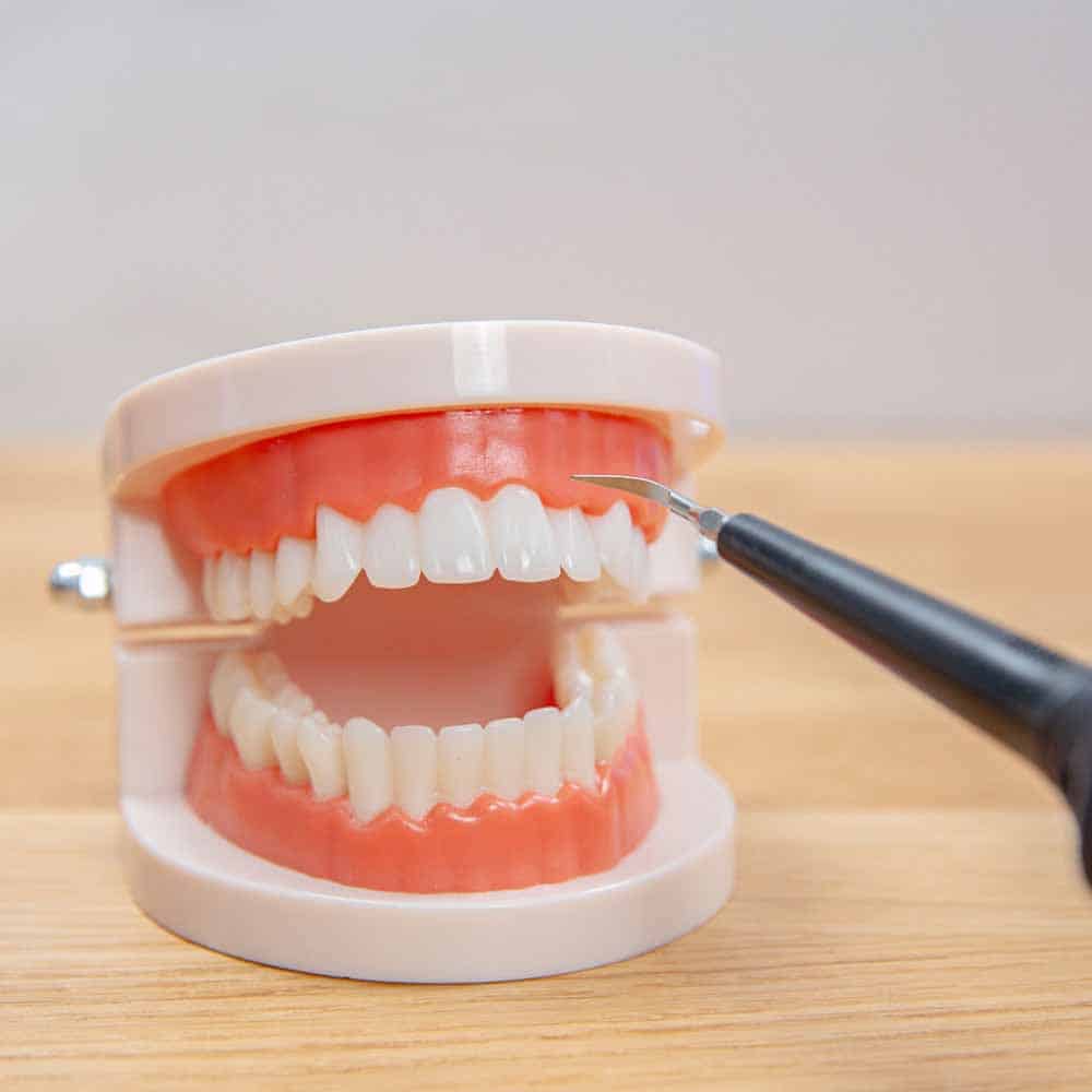 جرم گیری دندان - کلینیک دکتر زهرا شمسایی