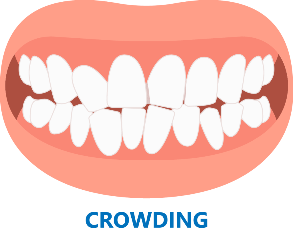 کراودینگ دندان - کلینیک دکتر زهرا شمسایی