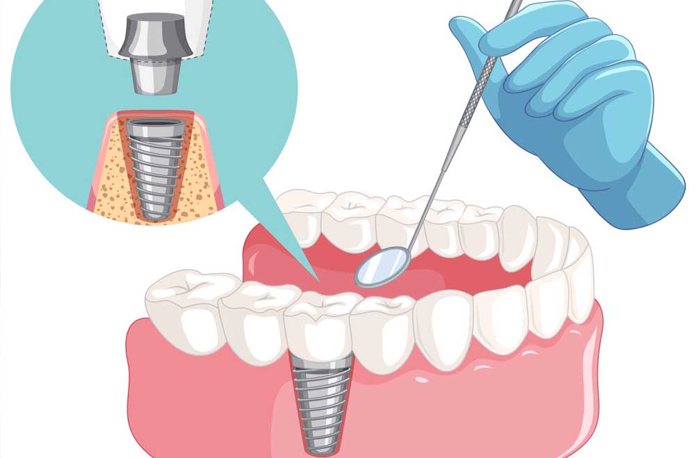 ایمپلنت دندان - کلینیک دندان پزشکی دکتر زهرا شمسایی