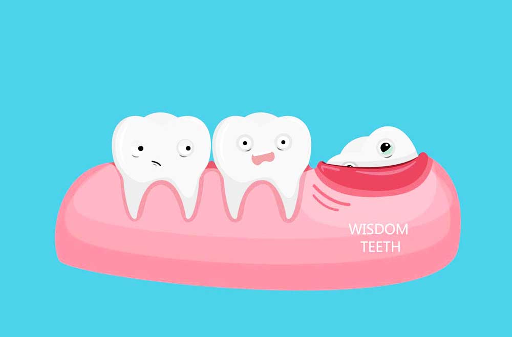 کشیدن دندان عقل - کلینیک دندانپزشکی دکتر زهرا شمسایی