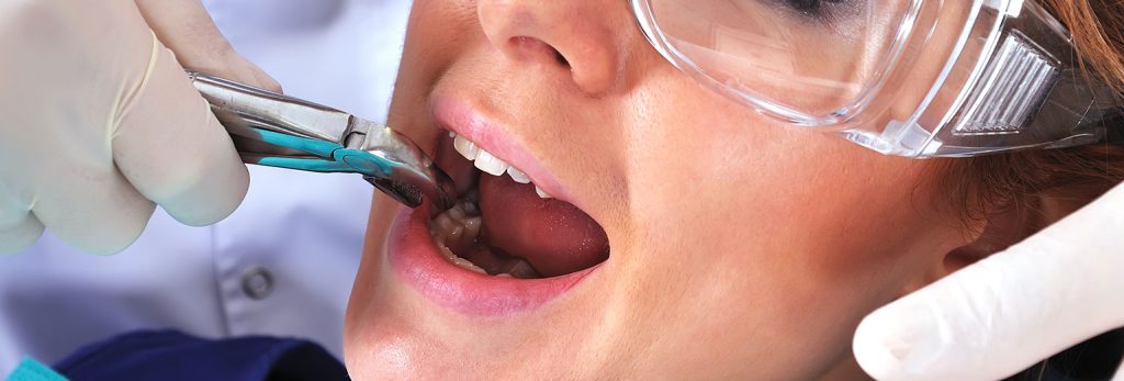 کشیدن دندان عقل - دکتر زهرا شمسایی