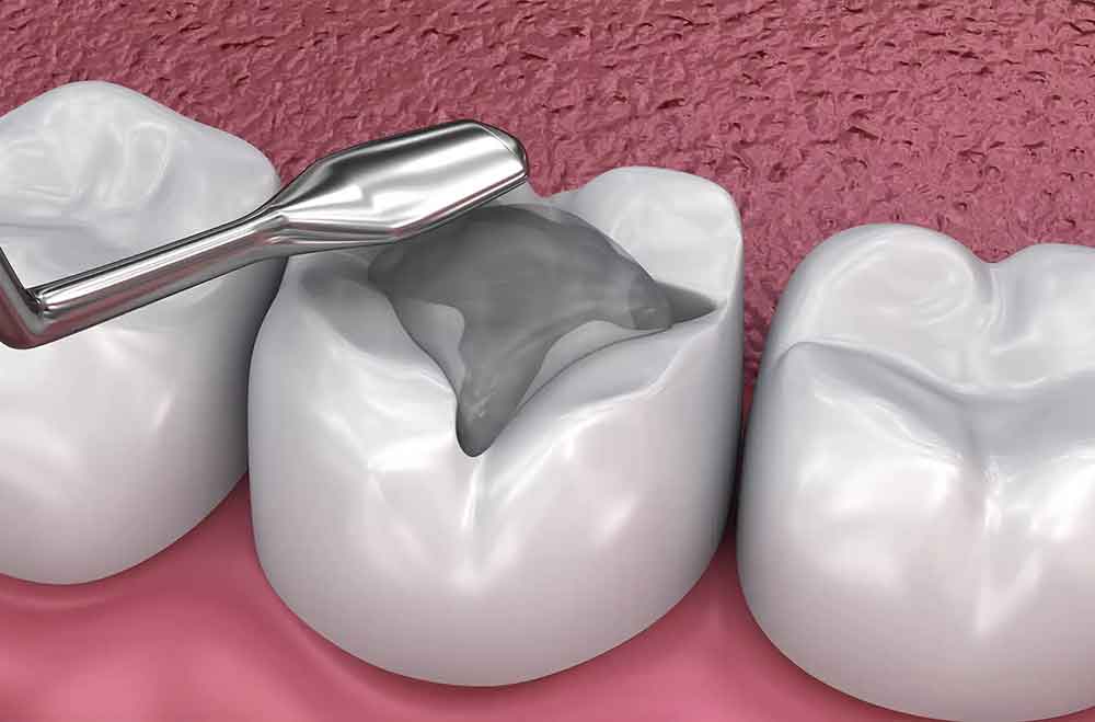 پر کردن دندان - کلینیک دکتر زهرا شمسایی