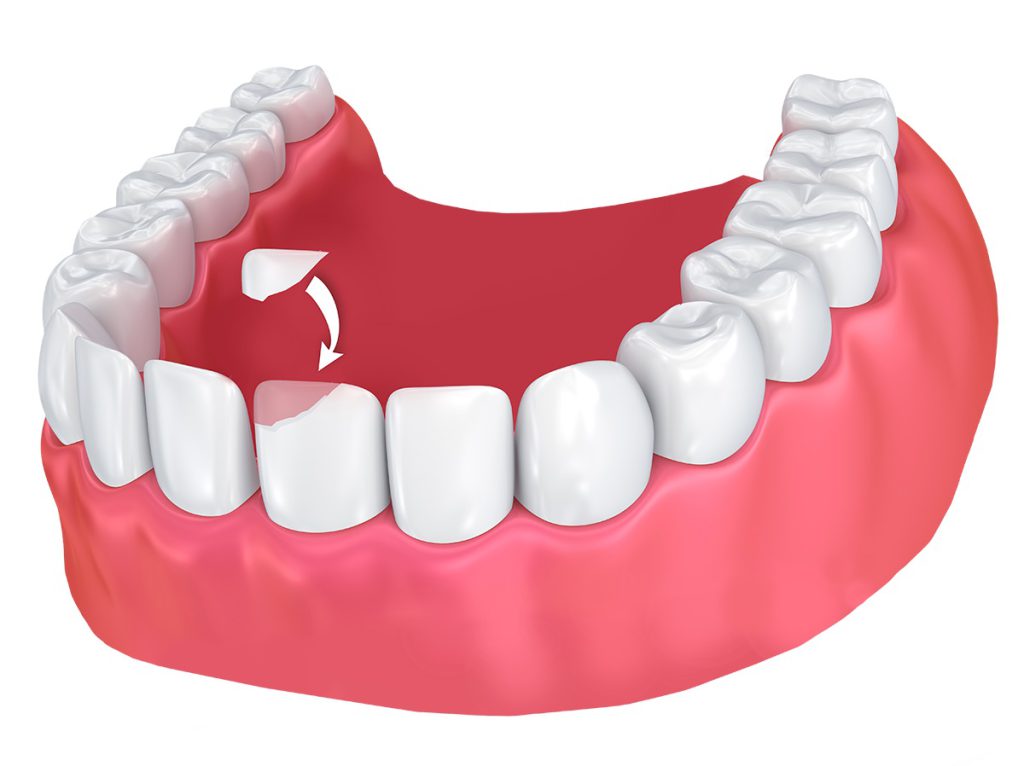 باندینگ دندان - کلینیک دکتر زهرا شمسایی