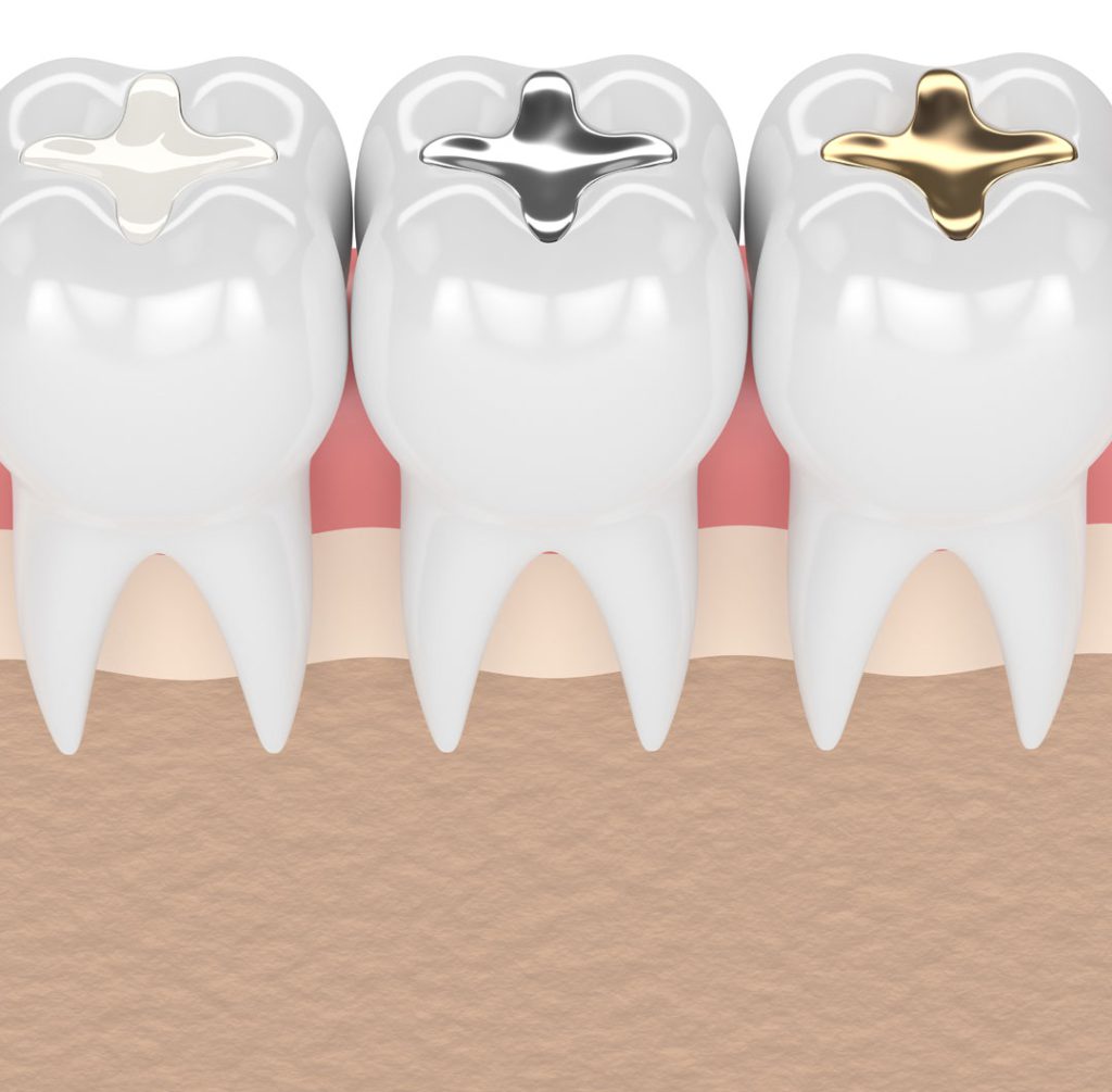 پر کردن دندان - کلینیک دکتر زهرا شمسایی