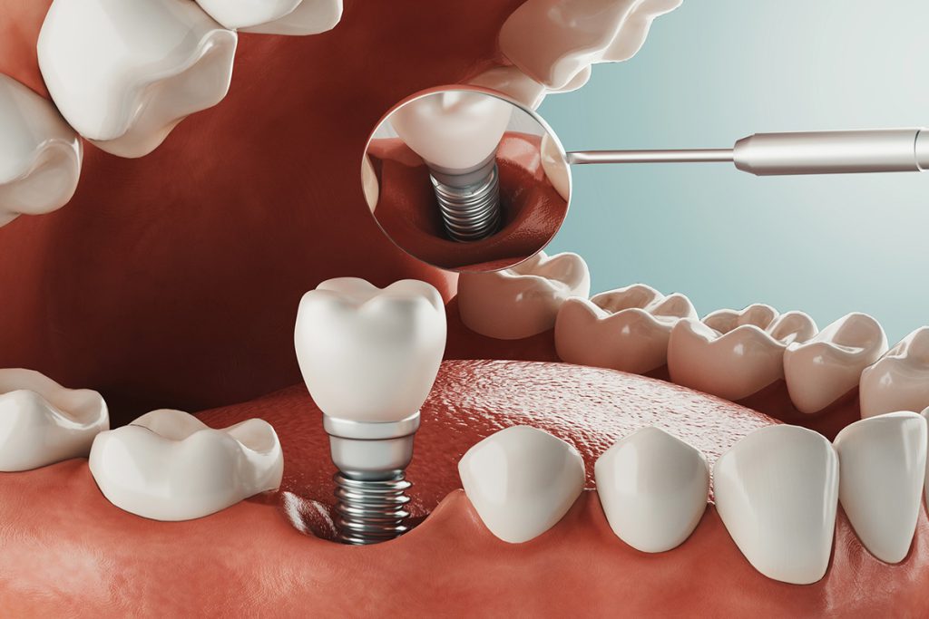ایمپلنت دندان - کاشت دندان - کلینیک دکتر زهرا شمسایی