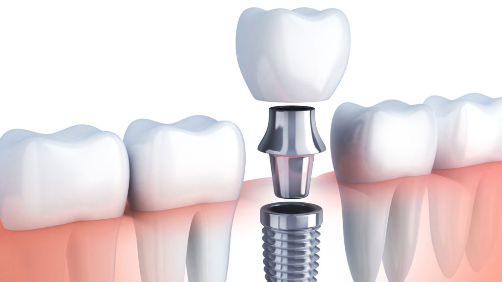 ایمپلنت دندان - کلینیک دکتر زهرا شمسایی
