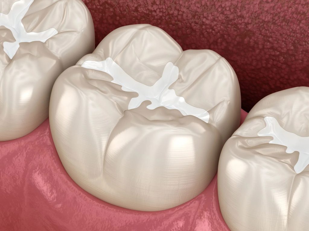 پر کردن دندان - کلینیک دکتر زهرا شمسایی