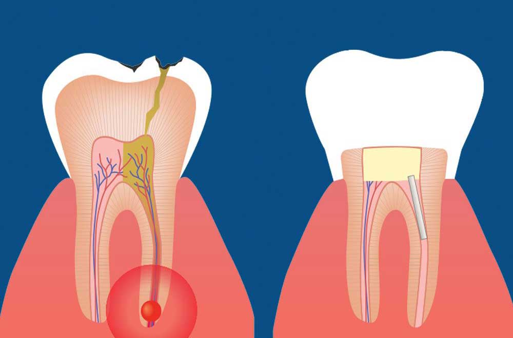 عصب کشی - کلینیک دکتر زهرا شمسایی