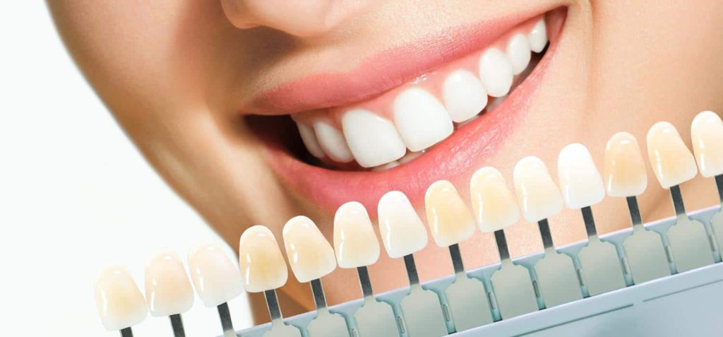 زرد شدن دندان - کلینیک دکت زهرا شمسایی