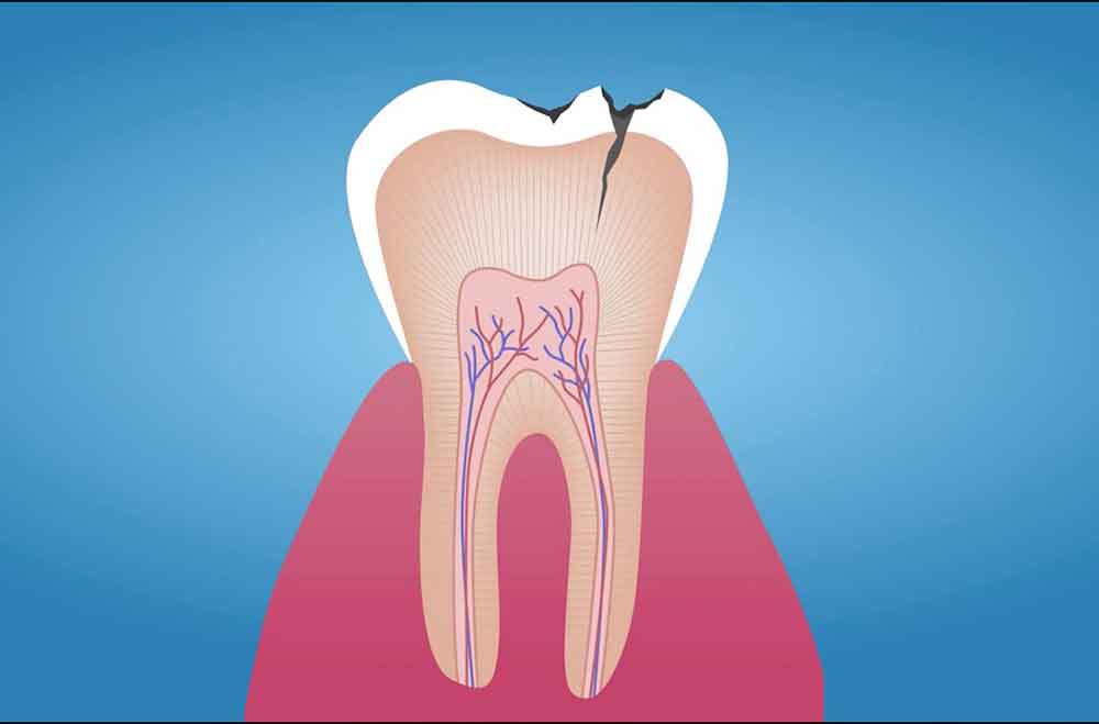 پوسیدگی دندان - کلینیک دکتر زهرا شمسایی