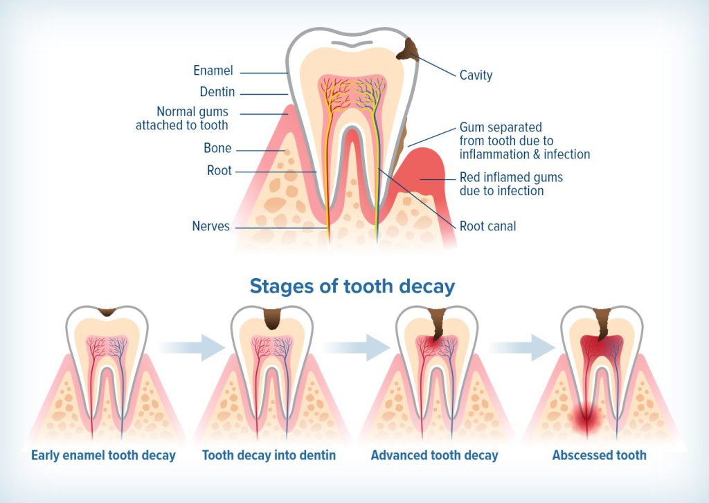 پوسیدگی دندان - کلینیک دکتر زهرا شمسایی