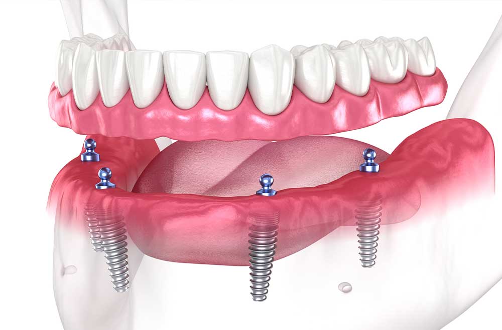 ایمپلنت دندان - کلینیک دکتر زهرا شمسایی