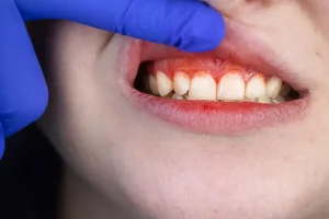 علت درد لثه بعد از ایمپلنت