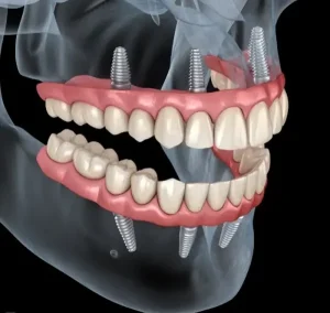 ایمپلنت فک بالا و پایین