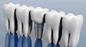 کاهش زمان درمان ایمپلنت