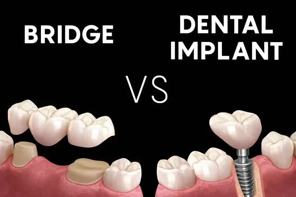 آیا بریج میتواند جایگزین ایمپلنت شود