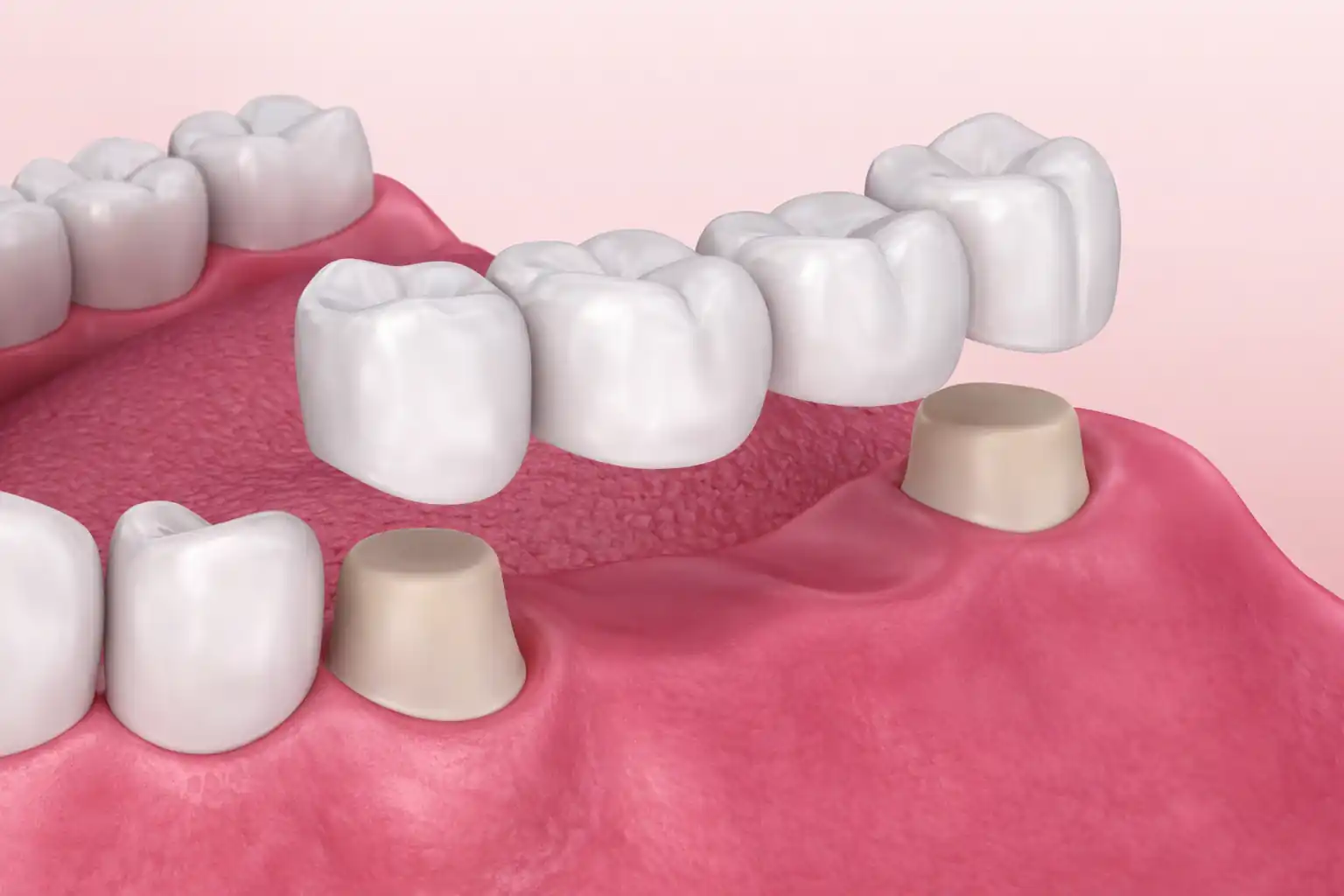 کاشت دندان بدون ایمپلنت